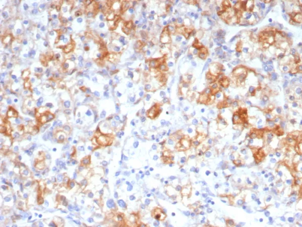 Formalin-fixed, paraffin-embedded human renal cell carcinoma stained with COX-2 Mouse Monoclonal Antibody (rCOX2/6996). HIER: Tris/EDTA, pH9.0, 45min. 2: HRP-polymer, 30min. DAB, 5min.