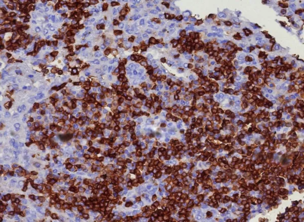 Formalin-fixed, paraffin-embedded human lymph node stained with CD45RA Recombinant Rabbit Monoclonal Antibody (PTPRC/8341R). HIER: Tris/EDTA, pH9.0, 45min. 2: HRP-polymer, 30min. DAB, 5min.