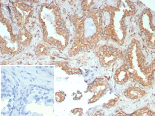 Formalin-fixed, paraffin-embedded human prostate carcinoma stained with RET Proto-oncogene Mouse Monoclonal Antibody (RET/7690). Inset: PBS instead of primary antibody; secondary only negative control.