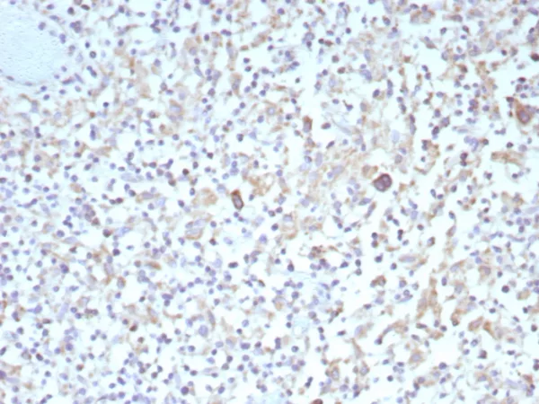 Formalin-fixed, paraffin-embedded human Hodgkin&apos;s lymphoma stained with Bcl-x Recombinant Rabbit Monoclonal Antibody (BCL2L1/9221R). HIER: Tris/EDTA, pH9.0, 45min. 2°C: HRP-polymer, 30min. DAB, 5min.