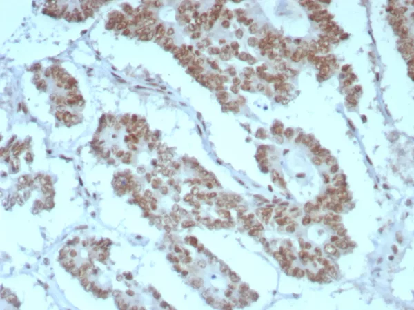 Formalin-fixed, paraffin-embedded human prostate stained with INI-1 Recombinant Mouse Monoclonal Antibody (rINI1/8850) HIER: Tris/EDTA, pH9.0, 45min. 2°C: HRP-polymer, 30min. DAB, 5min.