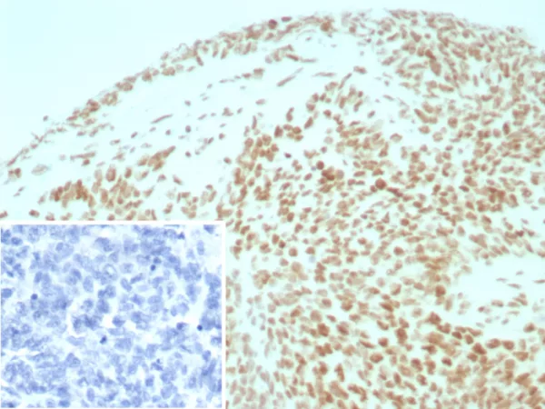 Formalin-fixed, paraffin-embedded human ovarian cancer stained with INI-1 Recombinant Rabbit Monoclonal Antibody (INI1/8935R) Inset: PBS instead of primary antibody; secondary only negative control.