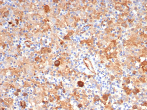 IHC analysis of formalin-fixed, paraffin-embedded human Hodgkin&apos;s lymphoma.  Cytoplasmic staining using FSCN1/7207 at 2ug/ml in PBS for 30min RT. HIER: Tris/EDTA, pH9.0, 45min. 2°C: HRP-polymer, 30min. DAB, 5min.