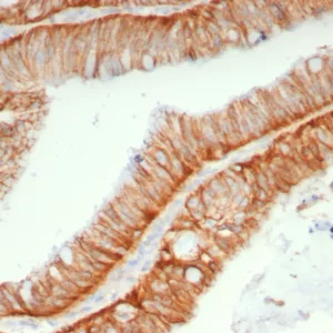 Formalin-fixed, paraffin-embedded human colon carcinoma stained with CD147 Mouse Monoclonal Antibody (BSG/7957). HIER: Tris/EDTA, pH9.0, 45min. 2°C: HRP-polymer, 30min. DAB, 5min.