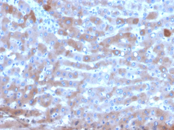 Formalin-fixed, paraffin-embedded human hepatocellular carcinoma stained with Transferrin Mouse Monoclonal Antibody (TF/4795). HIER: Tris/EDTA, pH9.0, 45min. 2°C: HRP-polymer, 30min. DAB, 5min.