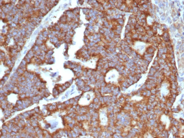 Formalin-fixed, paraffin-embedded human hepatocellular carcinoma stained with Transferrin Mouse Monoclonal Antibody (TF/4797). HIER: Tris/EDTA, pH9.0, 45min. 2: HRP-polymer, 30min. DAB, 5min.