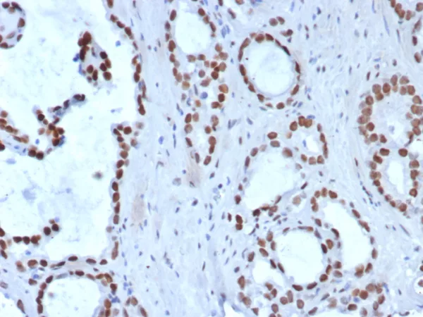 Formalin-fixed, paraffin-embedded human prostate carcinoma stained with TLE1 Rabbit Recombinant Monoclonal Antibody (TLE1/8007R). HIER: Tris/EDTA, pH9.0, 45min. 2: HRP-polymer, 30min. DAB, 5min.