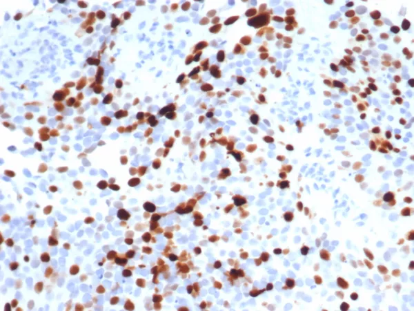 Formalin-fixed, paraffin-embedded human lymph node stained with Topo IIa Recombinant Rabbit Monoclonal Antibody (TOP2A/7148R). HIER: Tris/EDTA, pH9.0, 45min. 2°C: HRP-polymer, 30min. DAB, 5min.