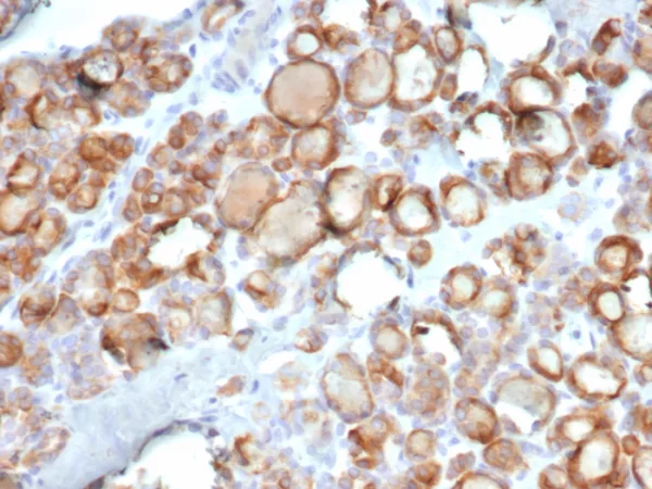 Formalin-fixed, paraffin-embedded human thyroid carcinoma stained with Thyroid Peroxidase Recombinant Rabbit Monoclonal Antibody (TPO/7088R). HIER: Tris/EDTA, pH9.0, 45min. 2°C: HRP-polymer, 30min. DAB, 5min.