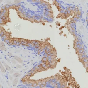 Formalin-fixed, paraffin-embedded human prostate carcinoma stained with Thymidylate Synthase Recombinant Rabbit Monoclonal (TYMS/9091R). HIER: Tris/EDTA, pH9.0, 45min. 2°C: HRP-polymer, 30min. DAB, 5min.