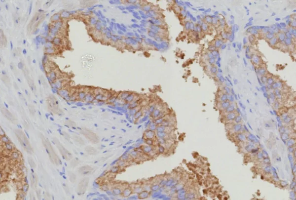 Formalin-fixed, paraffin-embedded human prostate carcinoma stained with Thymidylate Synthase Recombinant Rabbit Monoclonal (TYMS/9091R). HIER: Tris/EDTA, pH9.0, 45min. 2°C: HRP-polymer, 30min. DAB, 5min.