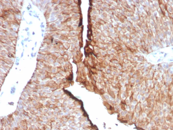 Formalin-fixed, paraffin-embedded human urothelial carcinoma stained with Uroplakin 1B Recombinant Rabbit Monoclonal Antibody (UPK1B/8976R). HIER: Tris/EDTA, pH9.0, 45min. 2°C: HRP-polymer, 30min. DAB, 5min.