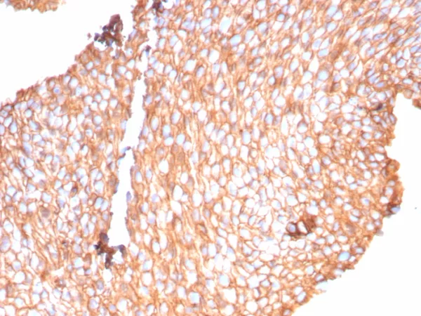 Formalin-fixed, paraffin-embedded human bladder carcinoma stained with Uroplakin 1B Recombinant Rabbit Monoclonal Antibody (UPK1B/9258R). HIER: Tris/EDTA, pH9.0, 45min. 2°C: HRP-polymer, 30min. DAB, 5min.