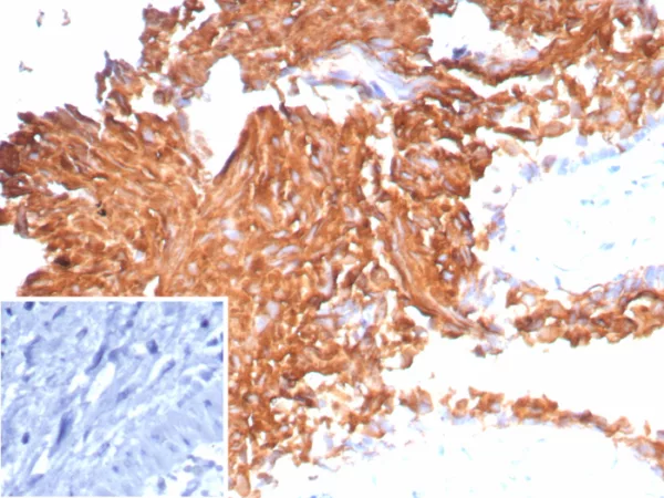 Formalin-fixed, paraffin-embedded human bladder carcinoma stained with Uroplakin 1B Recombinant Rabbit Monoclonal Antibody (UPK1B/9258R). Inset: PBS instead of primary antibody; secondary only negative control.