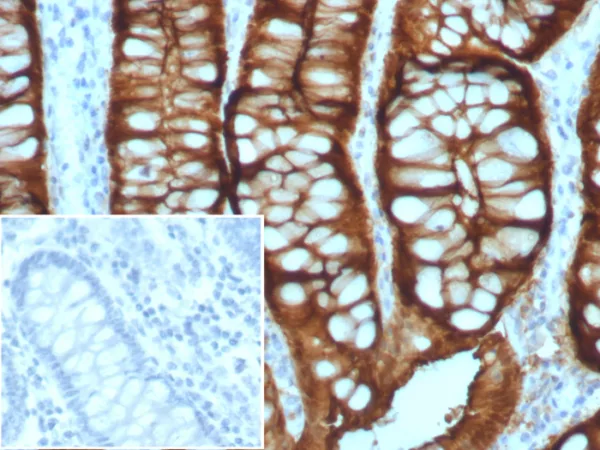 Formalin-fixed, paraffin-embedded human colon adenocarcinoma stained with Villin Recombinant Rabbit Monoclonal Antibody (VIL1/8105R). Inset: PBS instead of primary antibody; secondary only negative control.