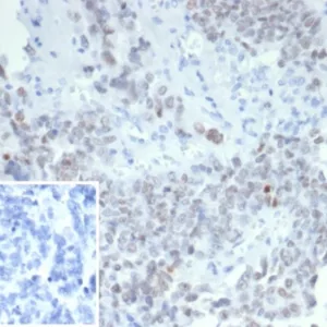 Formalin-fixed, paraffin-embedded human ovarian carcinoma stained with Wilm&apos;s Tumor Mouse Monoclonal Antibody (WT1/7452). Inset: PBS instead of primary antibody; secondary only negative control.