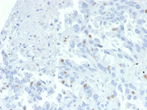 Formalin-fixed, paraffin-embedded human tumor of unknown origin stained with ZNF232 Mouse Monoclonal Antibody (PCRP-ZNF232-2B3). HIER: Tris/EDTA, pH9.0, 45min. 2°C: HRP-polymer, 30min. DAB, 5min.