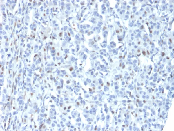 Formalin-fixed, paraffin-embedded human tumor of unknown origin stained with ZNF232 Mouse Monoclonal Antibody (PCRP-ZNF232-1D5). HIER: Tris/EDTA, pH9.0, 45min. 2°C: HRP-polymer, 30min. DAB, 5min.