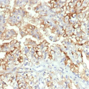 Formalin-fixed, paraffin-embedded human kidney carcinoma stained with CD276 / B7-H3 Mouse Monoclonal Antibody (B7H3/4312) at 2ug/ml. HIER: Tris/EDTA, pH9.0, 45min. 2°C: HRP-polymer, 30min. DAB, 5min.