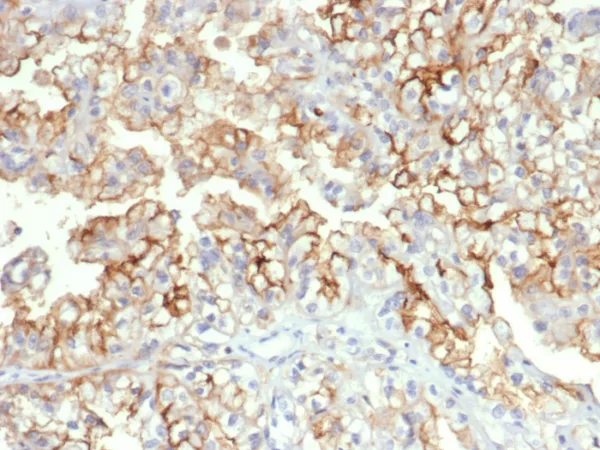 Formalin-fixed, paraffin-embedded human kidney carcinoma stained with CD276 / B7-H3 Mouse Monoclonal Antibody (B7H3/4312) at 2ug/ml. HIER: Tris/EDTA, pH9.0, 45min. 2°C: HRP-polymer, 30min. DAB, 5min.