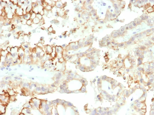 Formalin-fixed, paraffin-embedded human kidney carcinoma stained with CD276 / B7-H3 Mouse Monoclonal Antibody (B7H3/4313) at 2ug/ml. HIER: Tris/EDTA, pH9.0, 45min. 2°C: HRP-polymer, 30min. DAB, 5min.