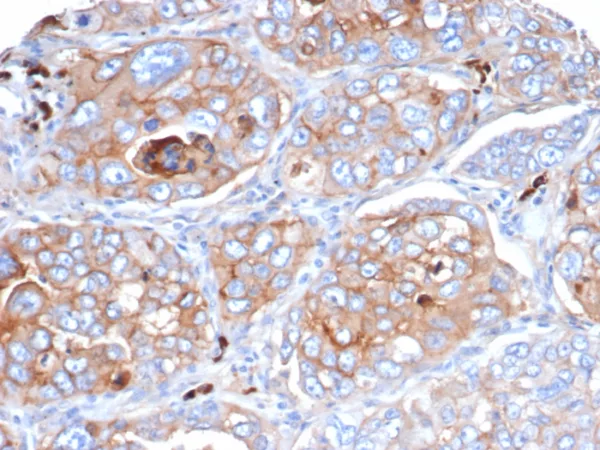 Formalin-fixed, paraffin-embedded human lung cancer stained with CD276 / B7-H3 Mouse Monoclonal Antibody (B7H3/4479) at 2ug/ml. HIER: Tris/EDTA, pH9.0, 45min. 2°C: HRP-polymer, 30min. DAB, 5min.