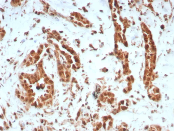 Formalin-fixed, paraffin-embedded human breast carcinoma stained with BAP1 Recombinant Rabbit Monoclonal Antibody (BAP1/8959R). HIER: Tris/EDTA, pH9.0, 45min. 2°C: HRP-polymer, 30min. DAB, 5min.