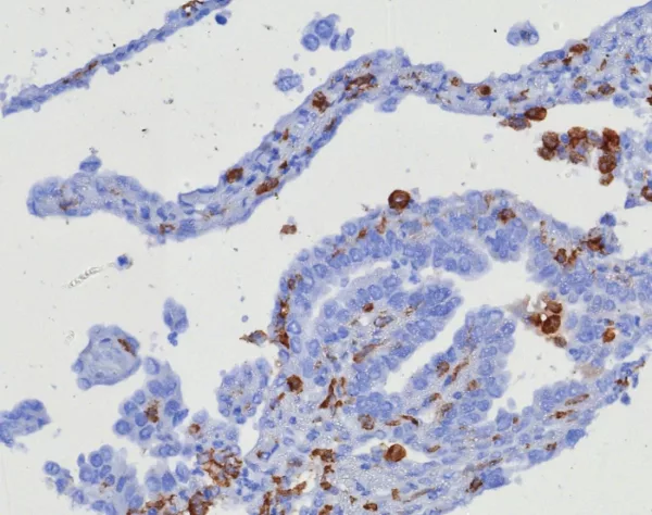 Formalin-fixed, paraffin-embedded human ovarian carcinoma stained with CD163 Recombinant Rabbit Monoclonal Antibody (M130/8361R). HIER: Tris/EDTA, pH9.0, 45min. 2: HRP-polymer, 30min. DAB, 5min.