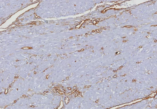 Formalin-fixed, paraffin-embedded human uterus stained with CD34 Rabbit Recombinant Monoclonal Antibody (HPCA1/8333R). HIER: Tris/EDTA, pH9.0, 45min. 2°C: HRP-polymer, 30min. DAB, 5min.