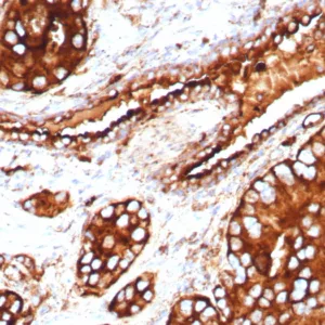 Formalin-fixed, paraffin-embedded human prostate stained with CD63 Recombinant Rabbit Monoclonal Antibody (LAMP3/8705R). HIER: Tris/EDTA, pH9.0, 45min. 2: HRP-polymer, 30min. DAB, 5min.