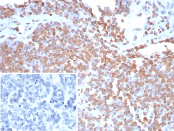 Formalin-fixed, paraffin-embedded human ovarian cancer stained with dsDNA Recombinant Mouse Monoclonal Antibody (rDSD/8266). Inset: PBS instead of primary antibody; secondary only negative control.