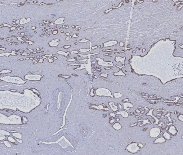 Formalin-fixed, paraffin-embedded human prostate carcinoma stained with Cytokeratin 5/6 Recombinant Rabbit Monoclonal Antibody (KRT5.6/8275R). HIER: Tris/EDTA, pH9.0, 45min. 2°C: HRP-polymer, 30min. DAB, 5min.