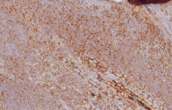 Formalin-fixed, paraffin-embedded human tonsil stained with HLA 1 ABC Recombinant Rabbit Monoclonal Antibody (MHC-I/8147R). HIER: Tris/EDTA, pH9.0, 45min. 2: HRP-polymer, 30min. DAB, 5min.