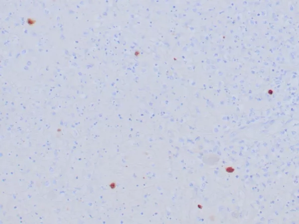 Formalin-fixed, paraffin-embedded human HSV-infected tissue stained with HSV1 Recombinant Rabbit Monoclonal Antibody (HSVI/8375R). HIER: Tris/EDTA, pH9.0, 45min. 2: HRP-polymer, 30min. DAB, 5min.