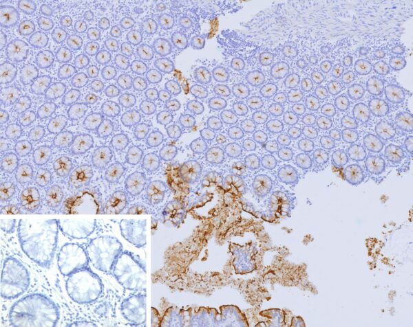 CEACAM5 Antibody in Immunohistochemistry (IHC (P))